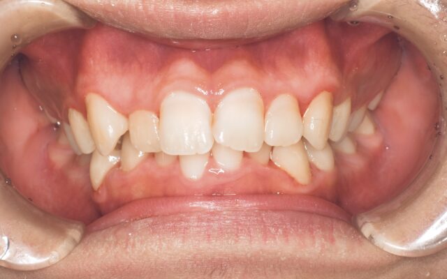 BEFORE