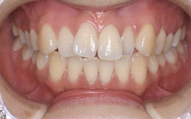 BEFORE